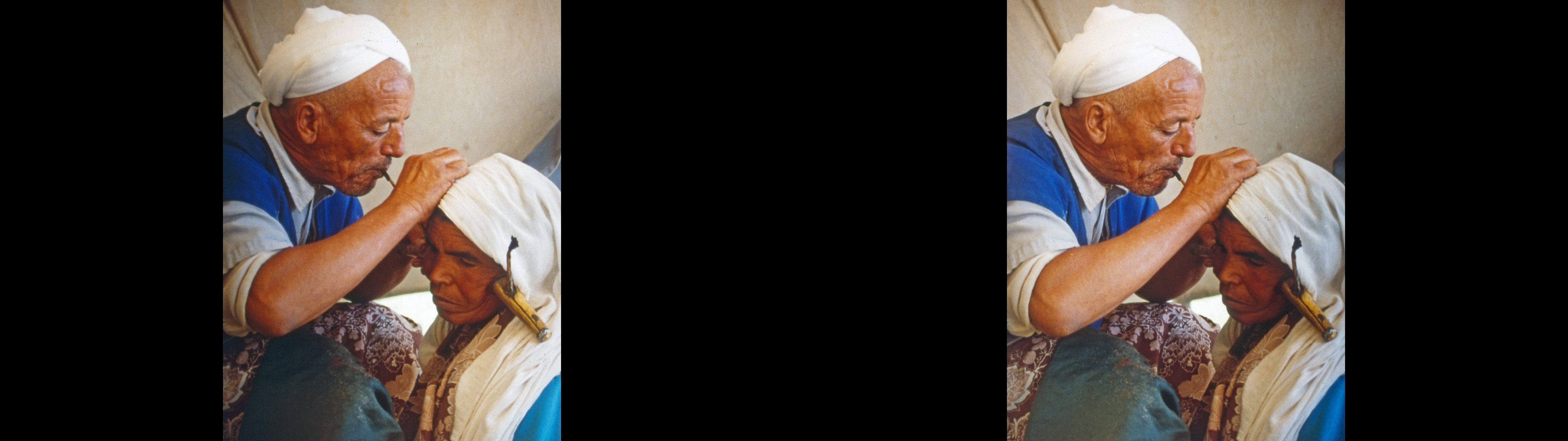 Opération de la saignée