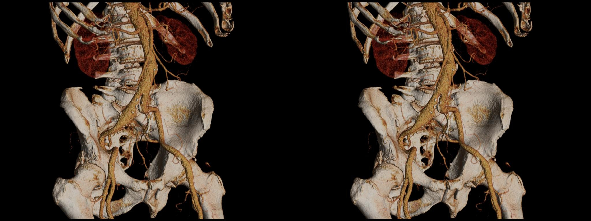 Anévrismes (Aneurysms) - 6°