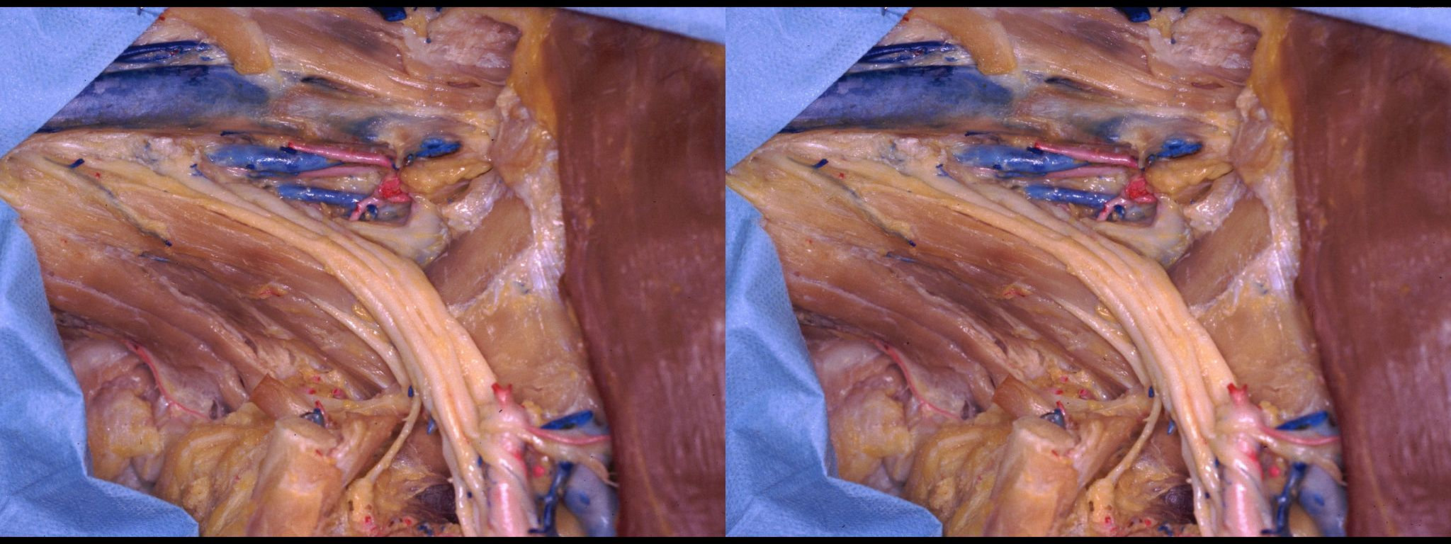 Plexus brachial - 15°